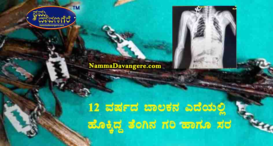 12 ವರ್ಷದ ಬಾಲಕನ ಎದೆಯಲ್ಲಿ ಹೊಕ್ಕಿದ್ದ ತೆಂಗಿನ ಗರಿ ಹಾಗೂ ಸರ